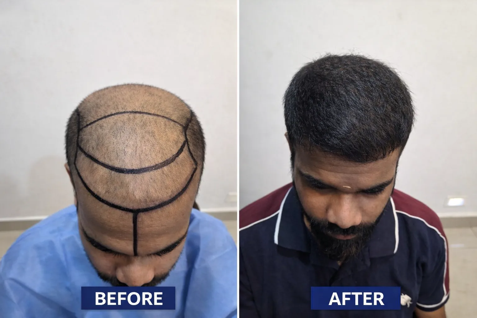 Hair transplant before and after result — Sapphire FUE