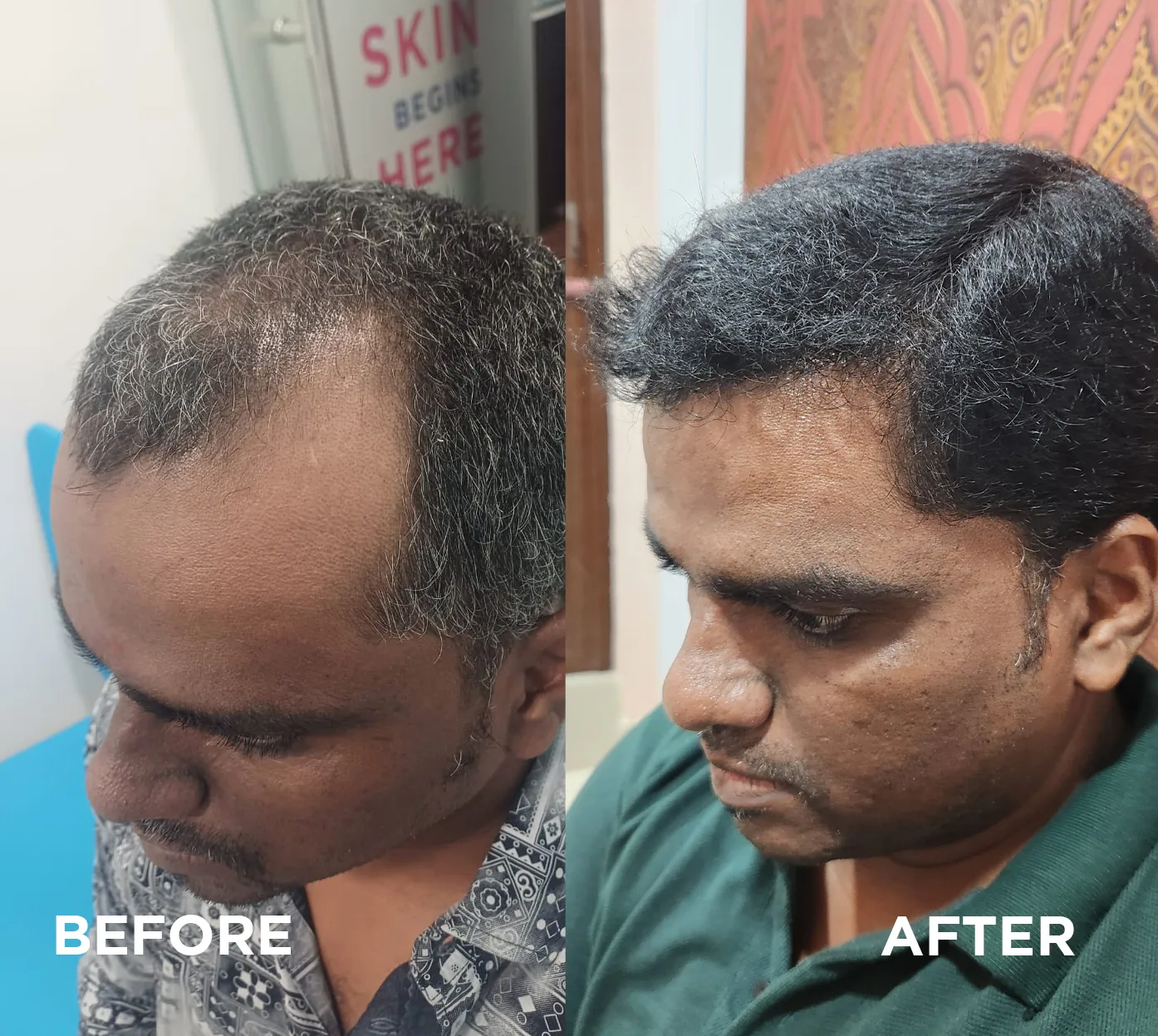 Hair transplant before and after result — Bio-FUE