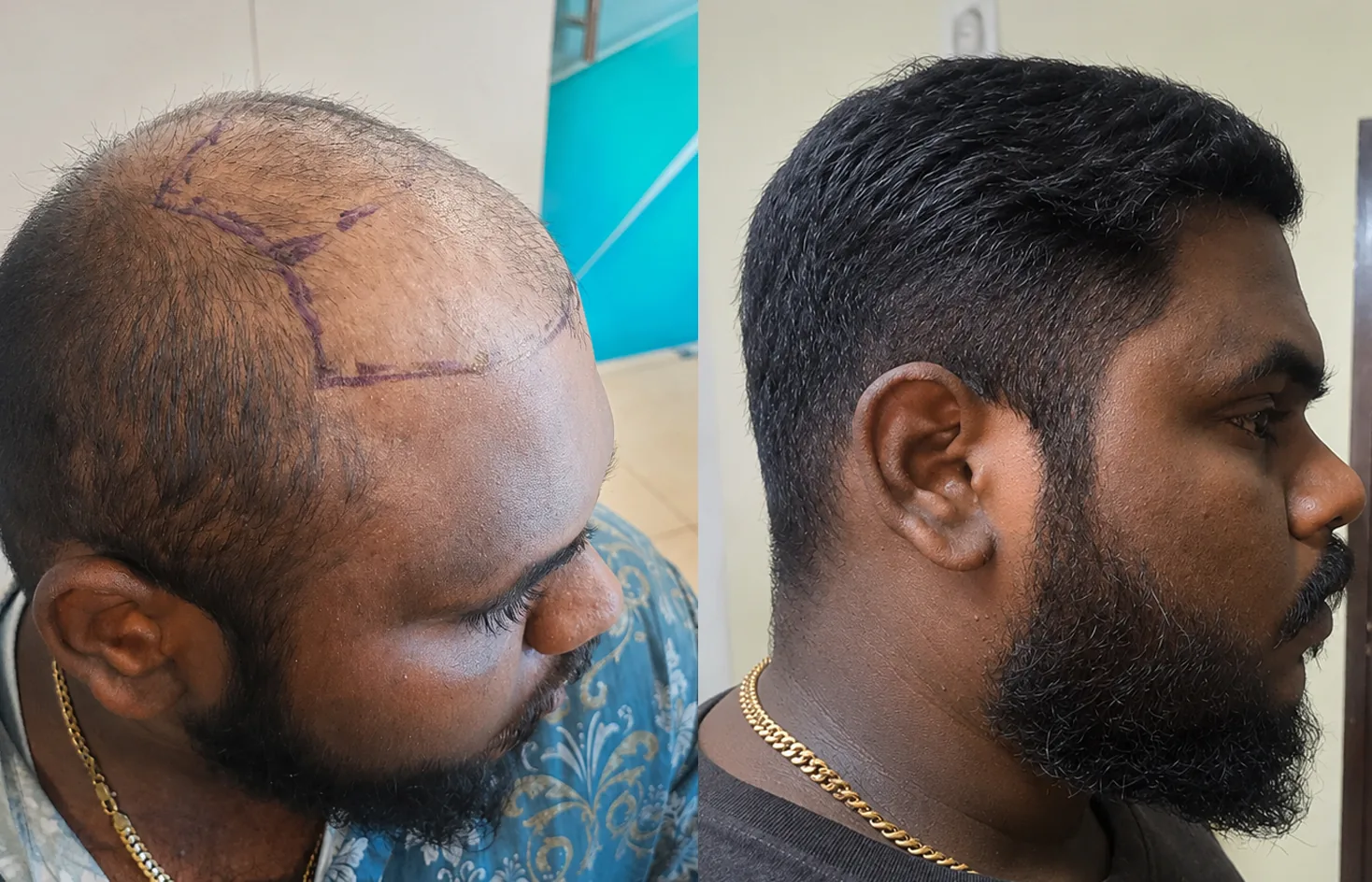 Hair transplant before and after result — Sapphire FUE