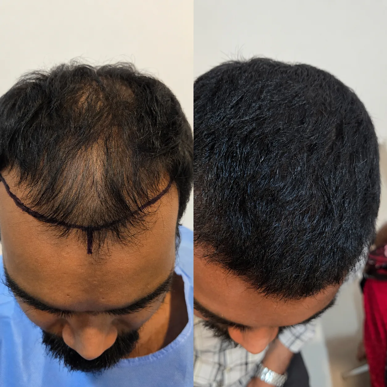 Hair transplant before and after result — DHI