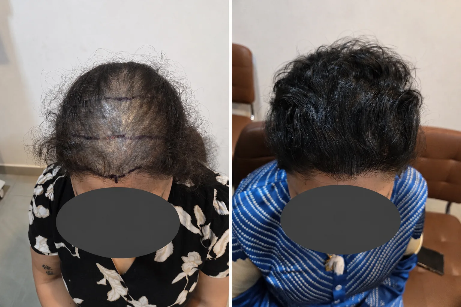 Hair transplant before and after result — DHI